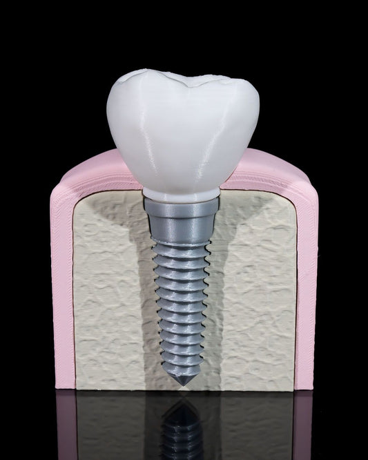 Dental Implant